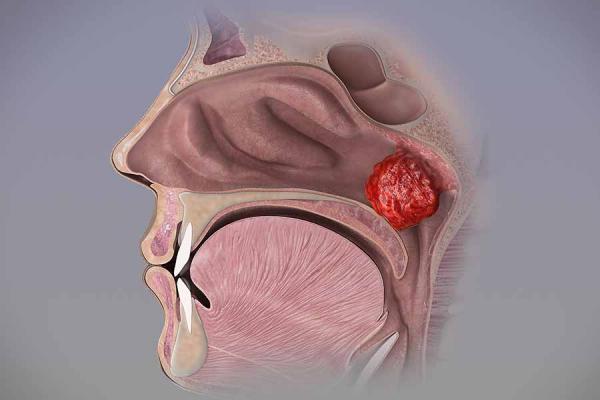 Nasenfleisch: bekannte Fehle