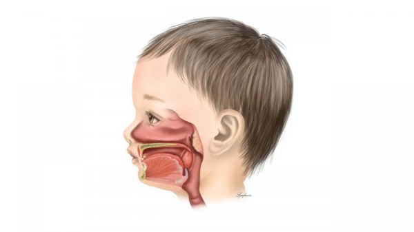 Childhood Sleep Apnea