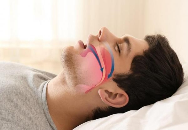 Sleep Apnea Treatment