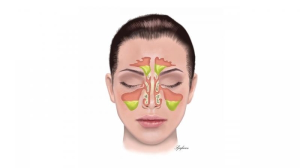 Nasen- und Nebenhöhlenerkrankungen