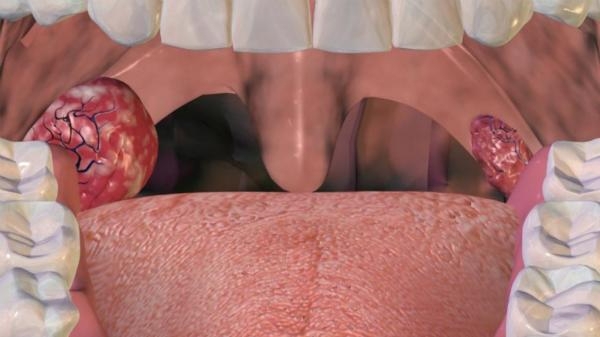 Adenoidchirurgie