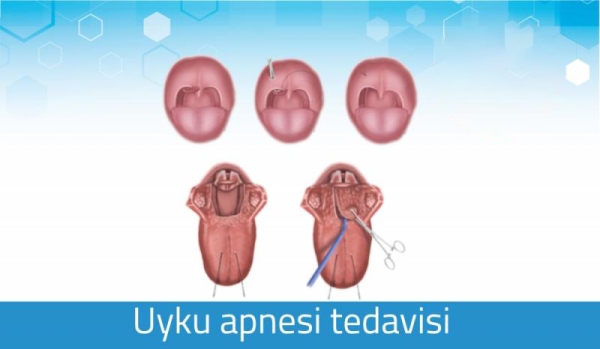 SORU CEVAPLARLA UYKU APNESİ TEDAVİSİ