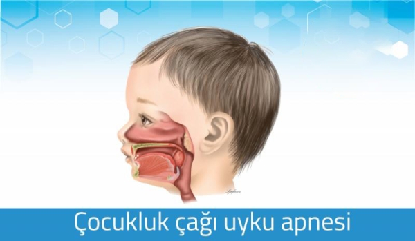 SORU CEVAPLARLA ÇOCUKLUK ÇAĞI UYKU APNESİ